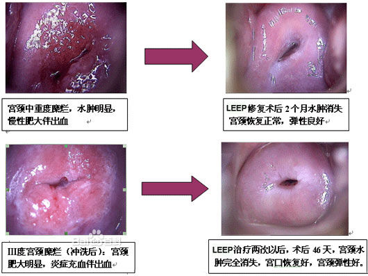 宫颈<em>肥大</em>_360百科