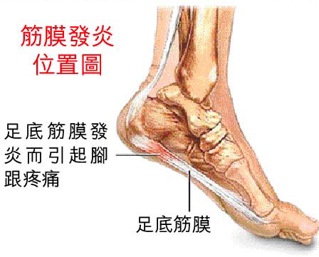 足底筋膜炎_360百科