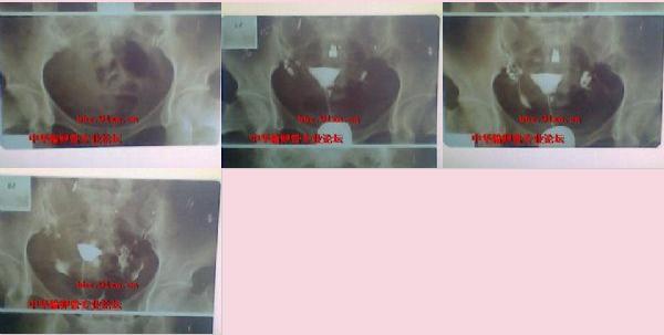 吃促排卵药就会引发卵巢囊肿