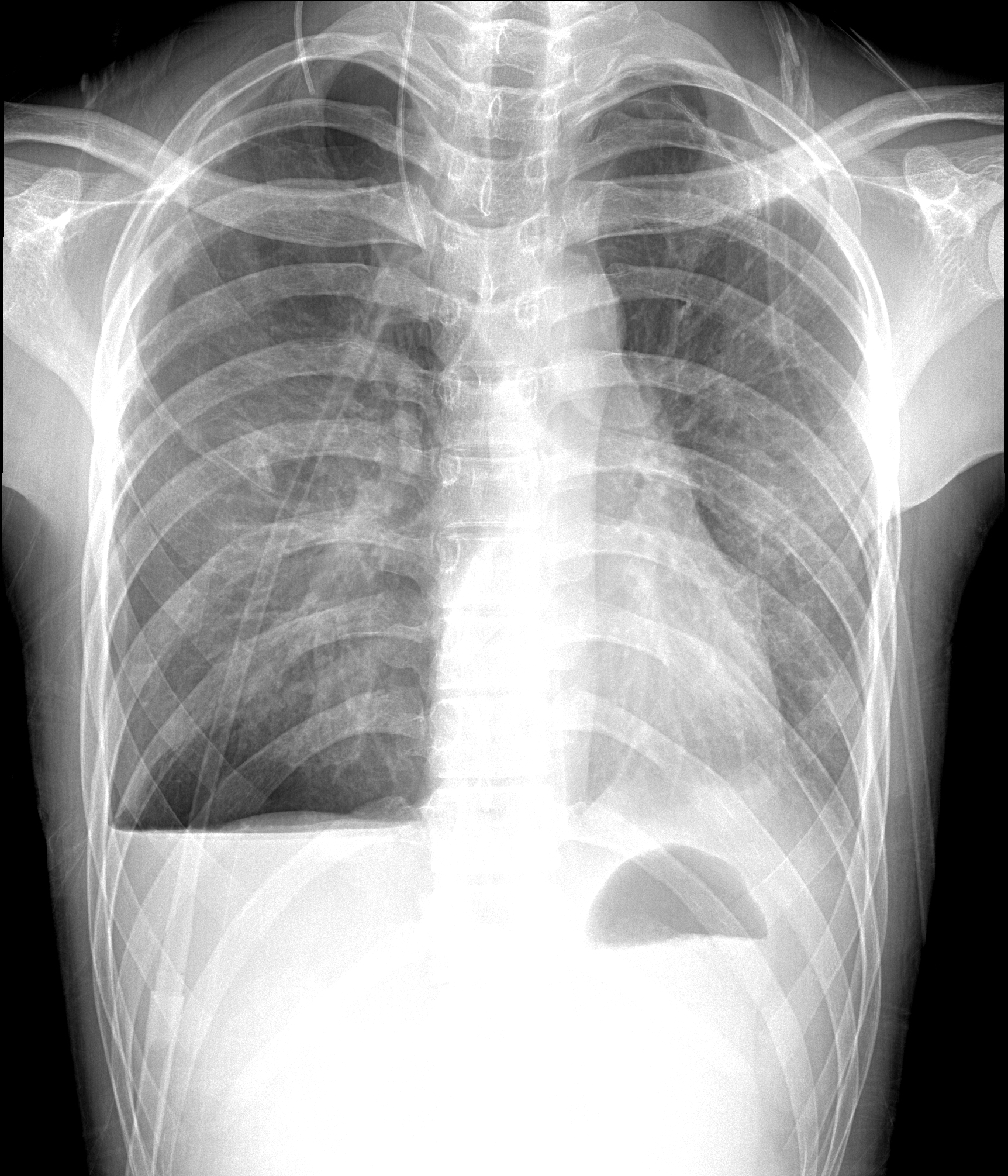 我照的胸透片，医生说是肺炎。请内科高手们也帮我看看。_百度知道