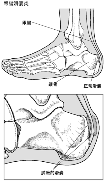 足跟滑囊炎